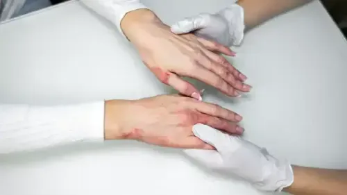 Coverage for Eczema Treatments in Health Insurance